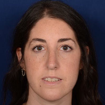 Female Rhinoplasty Before & After Gallery - Patient 566971 - Image 2