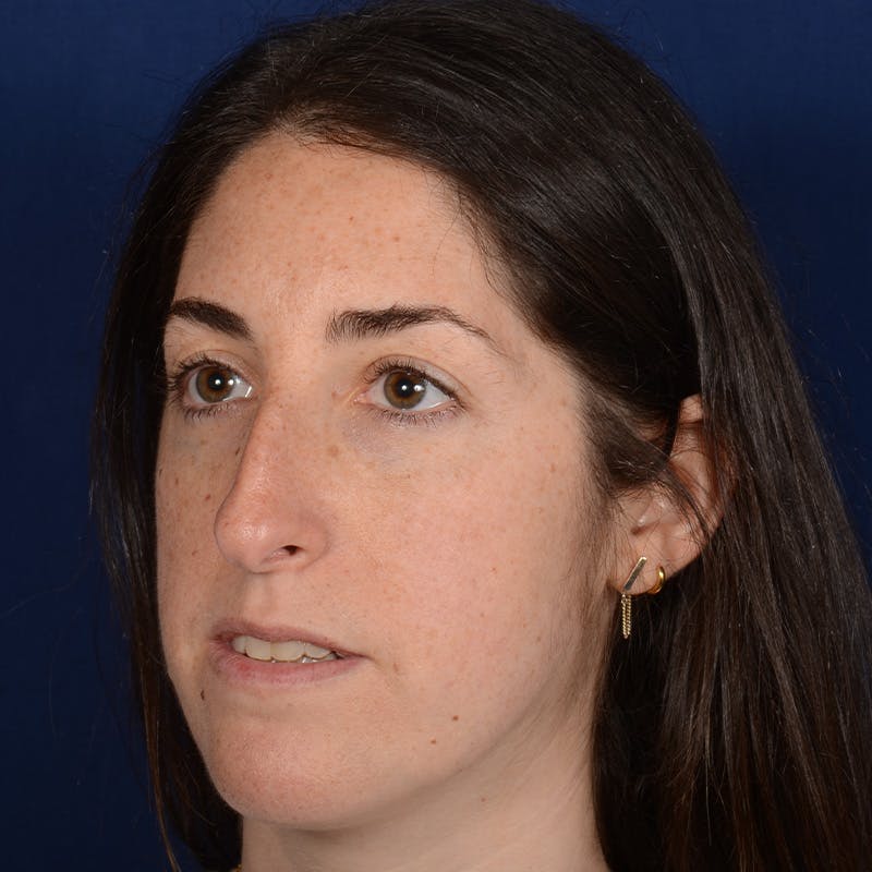 Female Rhinoplasty Before & After Gallery - Patient 566971 - Image 4