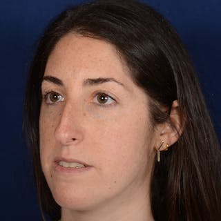 Female Rhinoplasty Before & After Gallery - Patient 566971 - Image 4