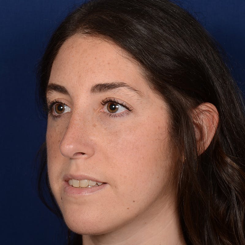 Female Rhinoplasty Before & After Gallery - Patient 566971 - Image 3