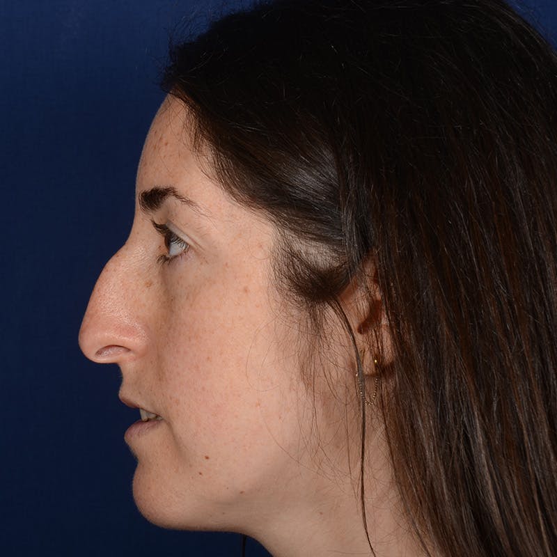 Female Rhinoplasty Before & After Gallery - Patient 566971 - Image 5