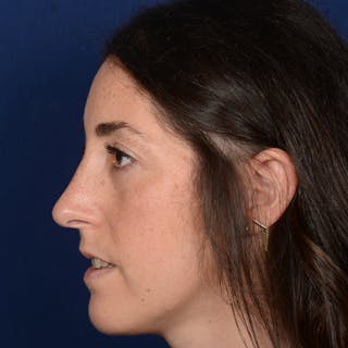 Female Rhinoplasty Before & After Gallery - Patient 566971 - Image 6