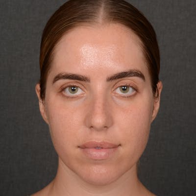 Female Rhinoplasty Before & After Gallery - Patient 168153 - Image 1