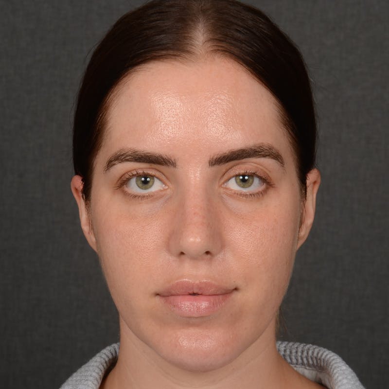 Female Rhinoplasty Before & After Gallery - Patient 168153 - Image 2