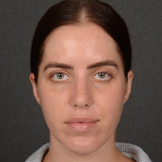 Female Rhinoplasty Before & After Gallery - Patient 168153 - Image 2