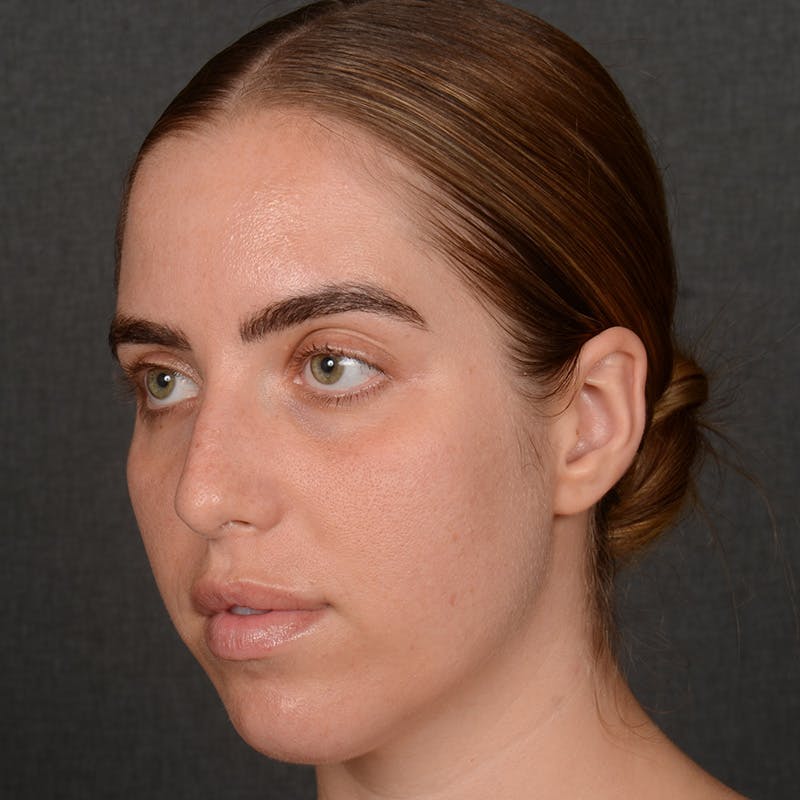 Female Rhinoplasty Before & After Gallery - Patient 168153 - Image 3