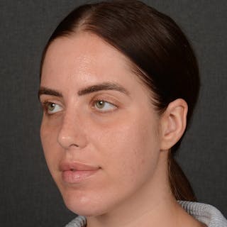 Female Rhinoplasty Before & After Gallery - Patient 168153 - Image 4