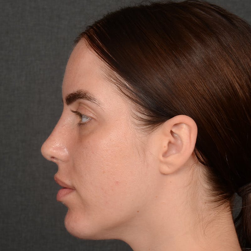 Female Rhinoplasty Before & After Gallery - Patient 168153 - Image 6