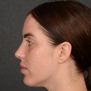Female Rhinoplasty Before & After Gallery - Patient 168153 - Image 6