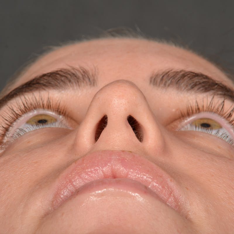 Female Rhinoplasty Before & After Gallery - Patient 168153 - Image 7