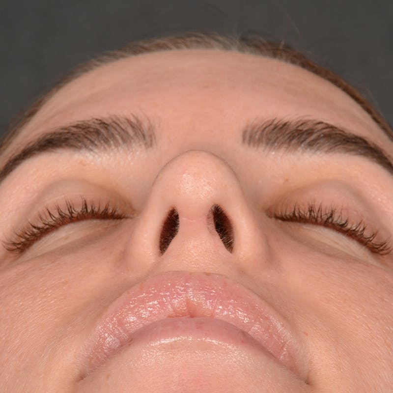 Female Rhinoplasty Before & After Gallery - Patient 168153 - Image 8