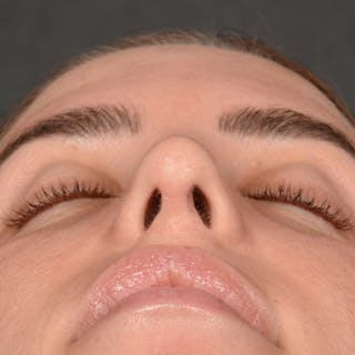 Female Rhinoplasty Before & After Gallery - Patient 168153 - Image 8