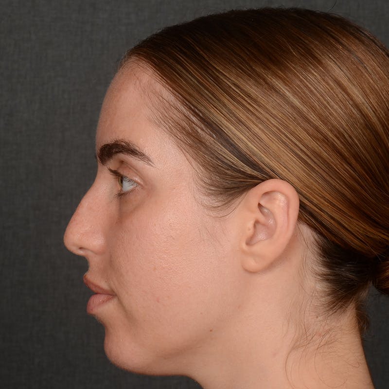 Female Rhinoplasty Before & After Gallery - Patient 168153 - Image 5