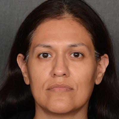 Female Rhinoplasty Before & After Gallery - Patient 168774 - Image 1