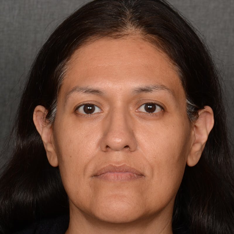 Female Rhinoplasty Before & After Gallery - Patient 168774 - Image 1