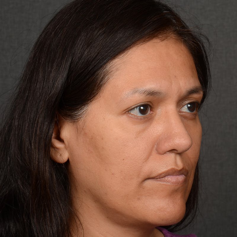 Female Rhinoplasty Before & After Gallery - Patient 168774 - Image 4
