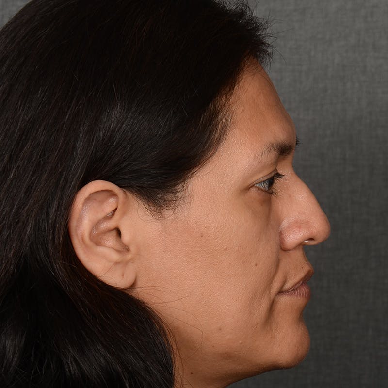 Female Rhinoplasty Before & After Gallery - Patient 168774 - Image 5