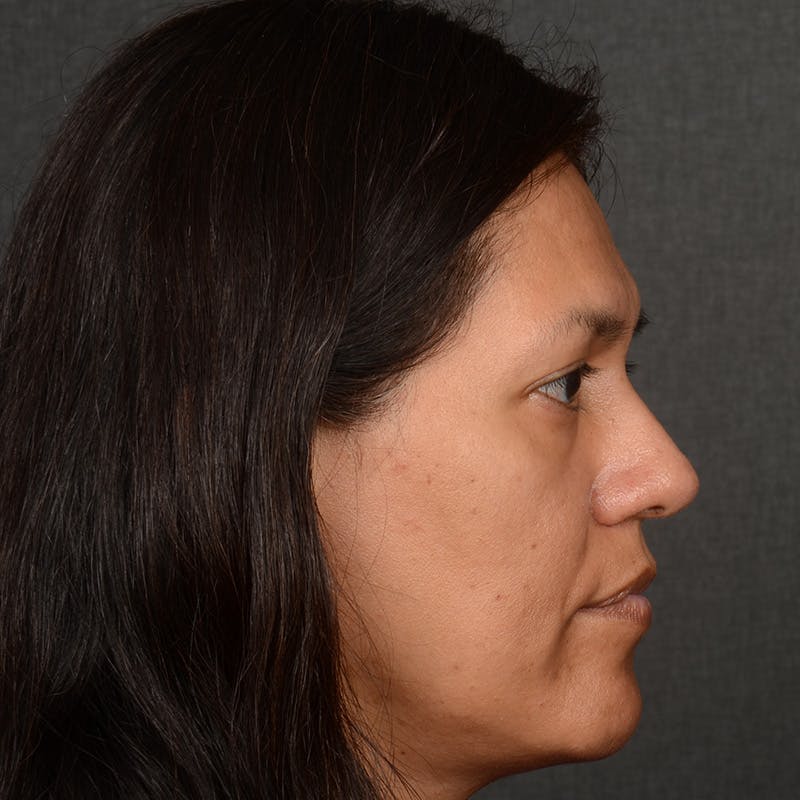 Female Rhinoplasty Before & After Gallery - Patient 168774 - Image 6