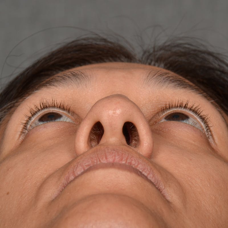 Female Rhinoplasty Before & After Gallery - Patient 168774 - Image 7