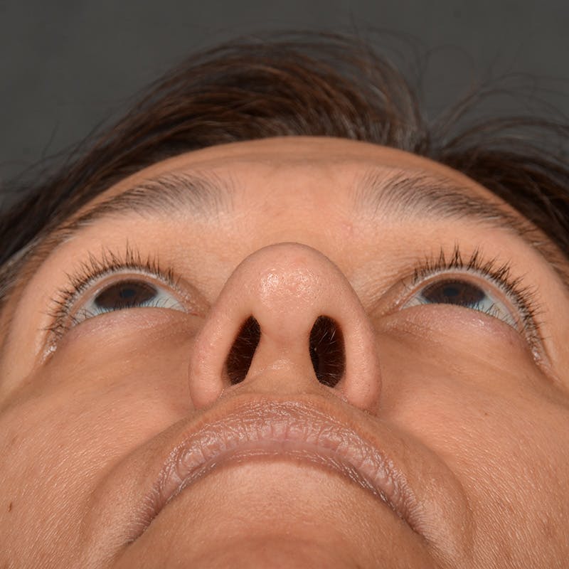 Female Rhinoplasty Before & After Gallery - Patient 168774 - Image 8