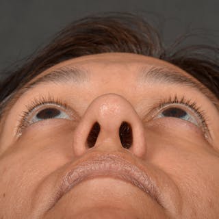 Female Rhinoplasty Before & After Gallery - Patient 168774 - Image 8