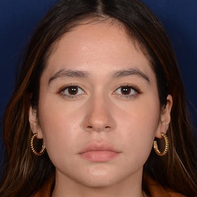 Female Rhinoplasty Before & After Gallery - Patient 349036 - Image 1