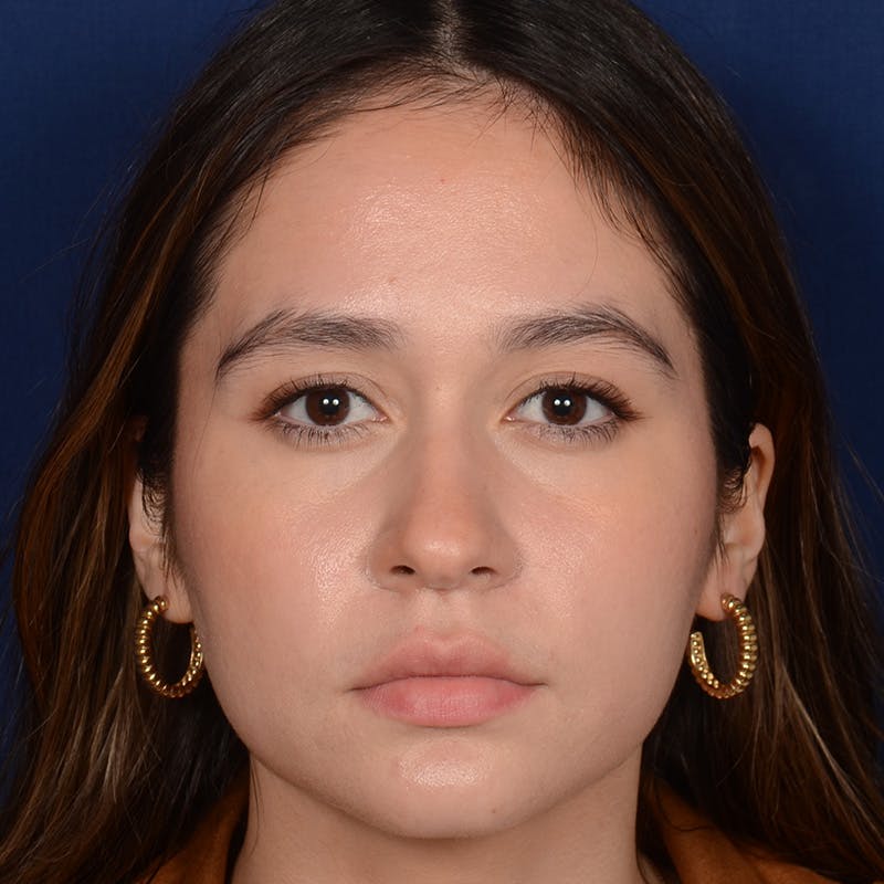Female Rhinoplasty Before & After Gallery - Patient 349036 - Image 1