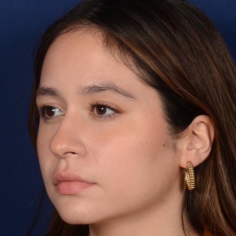 Female Rhinoplasty Before & After Gallery - Patient 349036 - Image 3