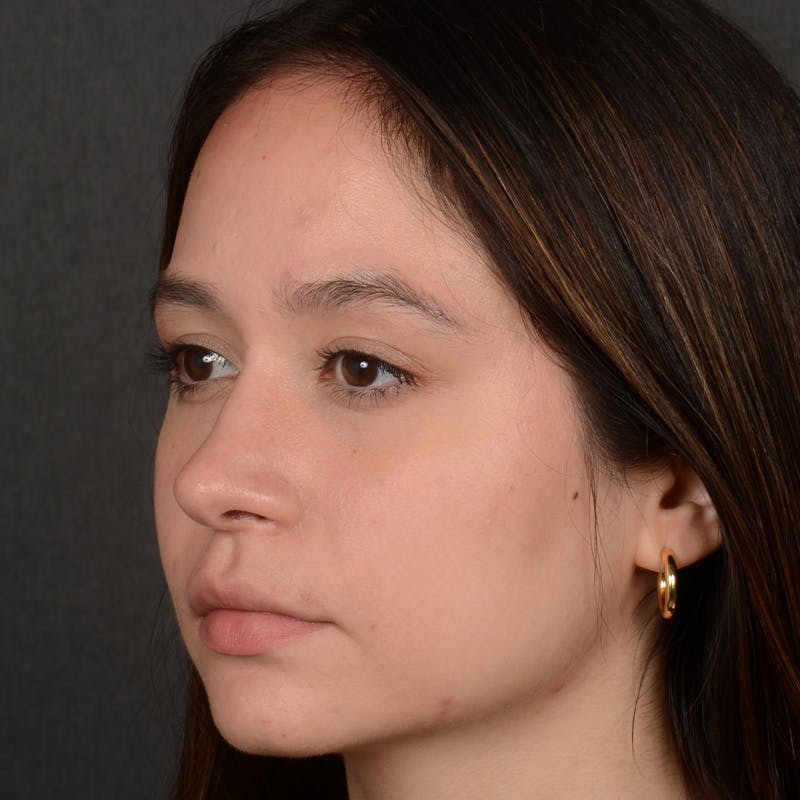 Female Rhinoplasty Before & After Gallery - Patient 349036 - Image 4