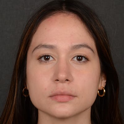 Female Rhinoplasty Before & After Gallery - Patient 349036 - Image 2