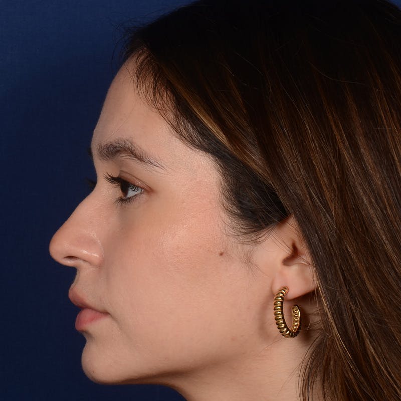 Female Rhinoplasty Before & After Gallery - Patient 349036 - Image 5
