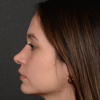 Female Rhinoplasty Before & After Gallery - Patient 349036 - Image 6