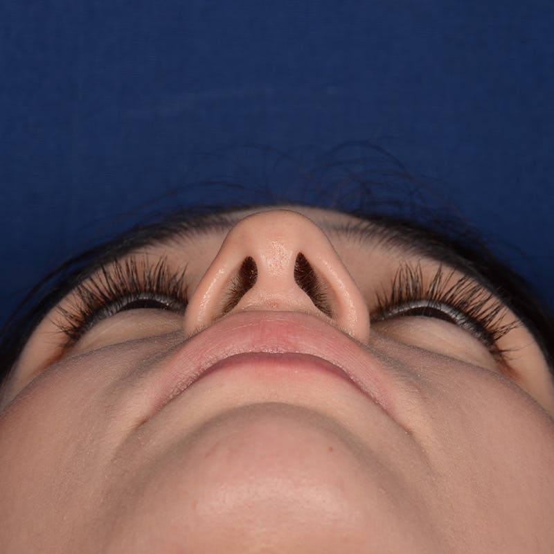 Female Rhinoplasty Before & After Gallery - Patient 349036 - Image 7