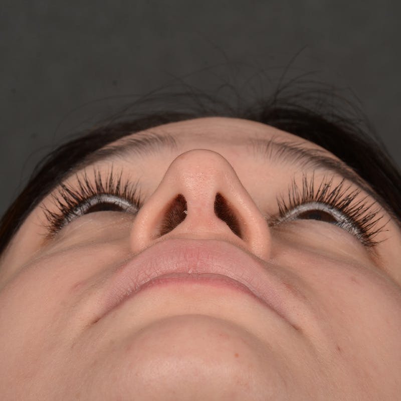 Female Rhinoplasty Before & After Gallery - Patient 349036 - Image 8
