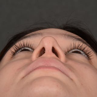 Female Rhinoplasty Before & After Gallery - Patient 349036 - Image 8