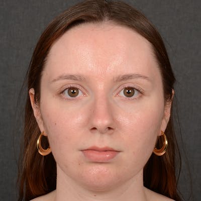 Female Rhinoplasty Before & After Gallery - Patient 144537 - Image 1