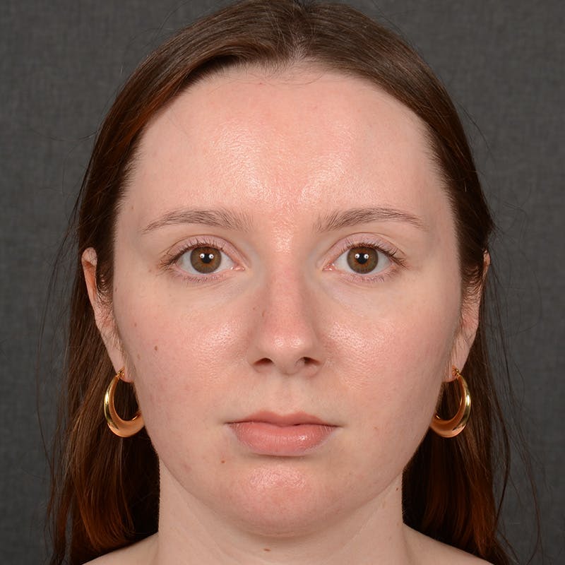 Female Rhinoplasty Before & After Gallery - Patient 144537 - Image 1