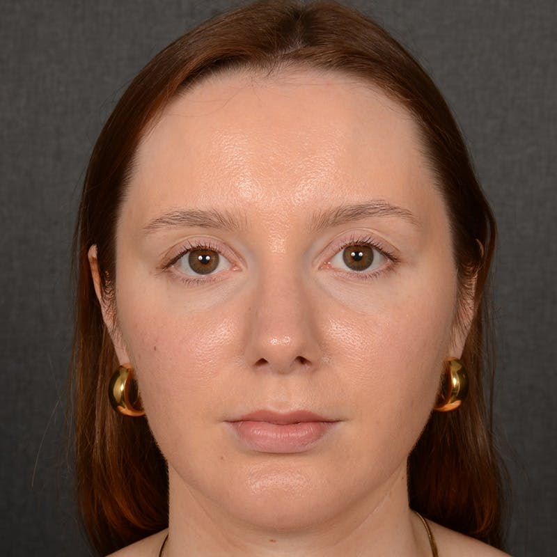 Female Rhinoplasty Before & After Gallery - Patient 144537 - Image 2