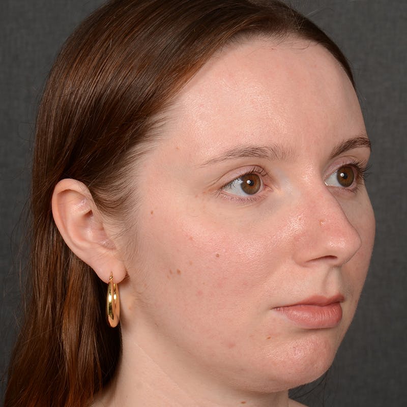 Female Rhinoplasty Before & After Gallery - Patient 144537 - Image 3