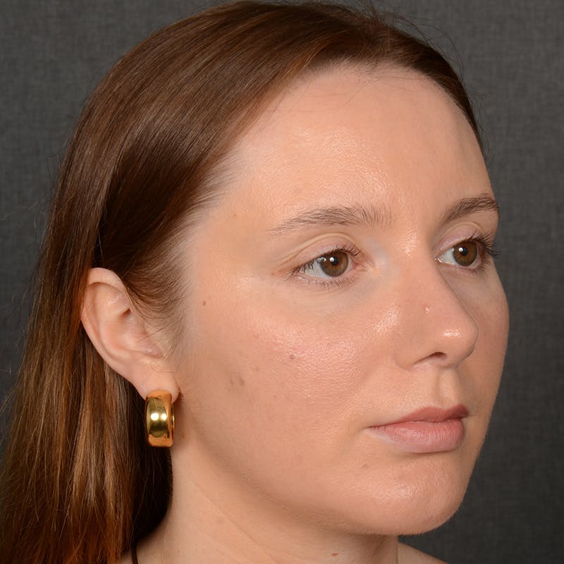 Female Rhinoplasty Before & After Gallery - Patient 144537 - Image 4