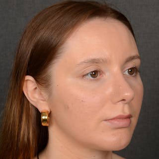 Female Rhinoplasty Before & After Gallery - Patient 144537 - Image 4