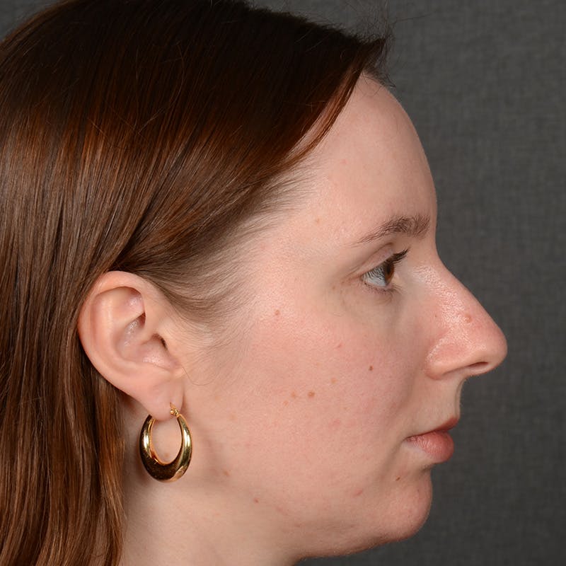 Female Rhinoplasty Before & After Gallery - Patient 144537 - Image 5