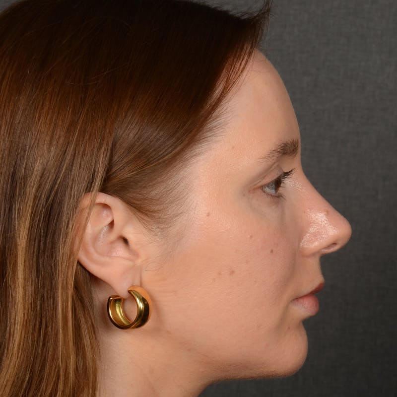 Female Rhinoplasty Before & After Gallery - Patient 144537 - Image 6