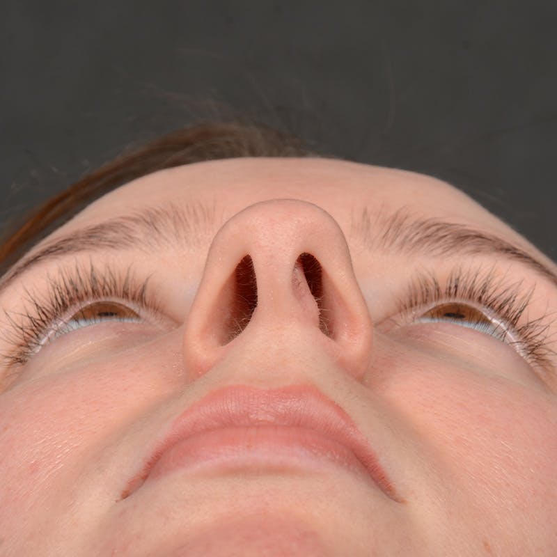 Female Rhinoplasty Before & After Gallery - Patient 144537 - Image 7