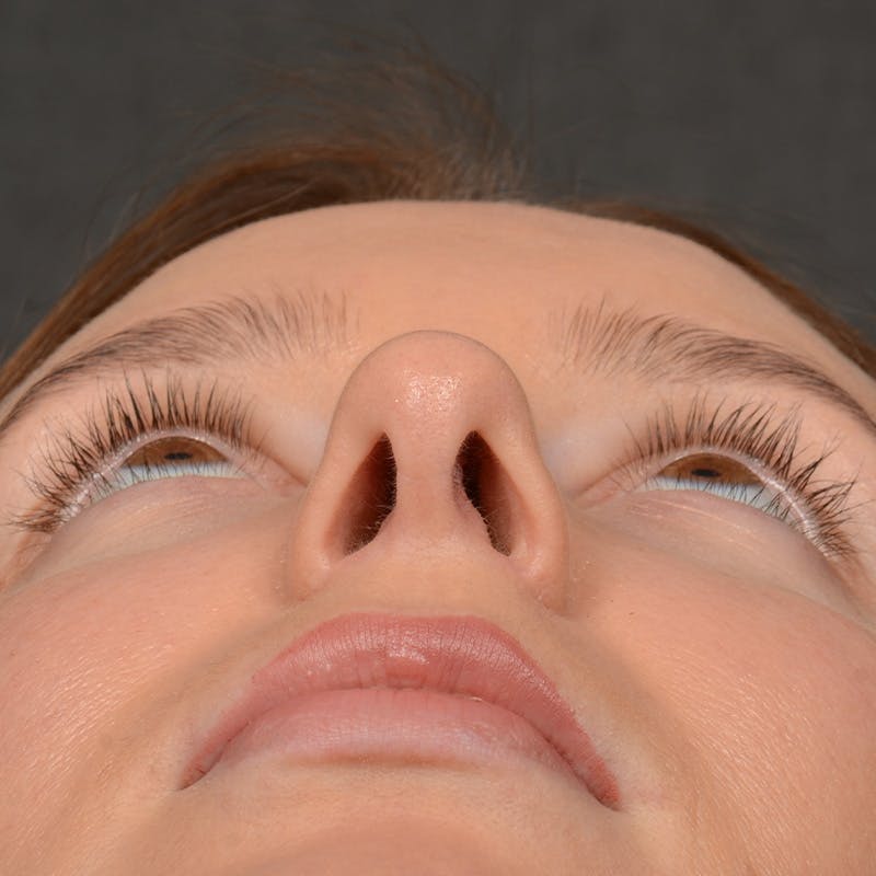 Female Rhinoplasty Before & After Gallery - Patient 144537 - Image 8