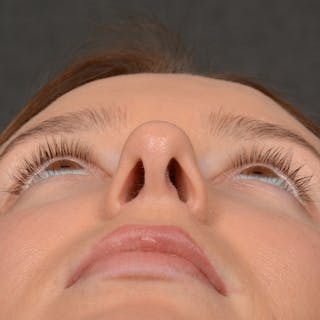 Female Rhinoplasty Before & After Gallery - Patient 144537 - Image 8