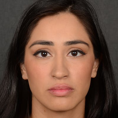 Female Rhinoplasty Before & After Gallery - Patient 303772 - Image 1