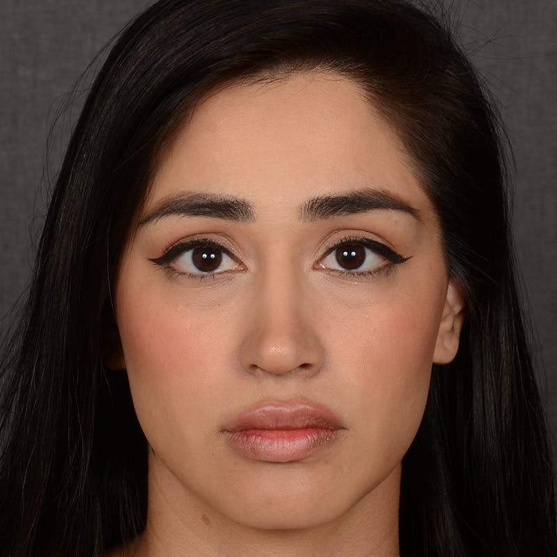 Female Rhinoplasty Before & After Gallery - Patient 303772 - Image 2