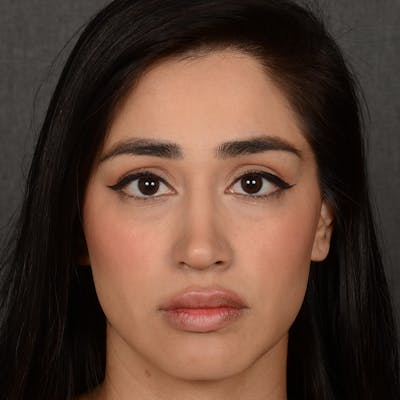 Female Rhinoplasty Before & After Gallery - Patient 303772 - Image 2