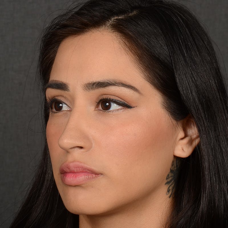 Female Rhinoplasty Before & After Gallery - Patient 303772 - Image 3